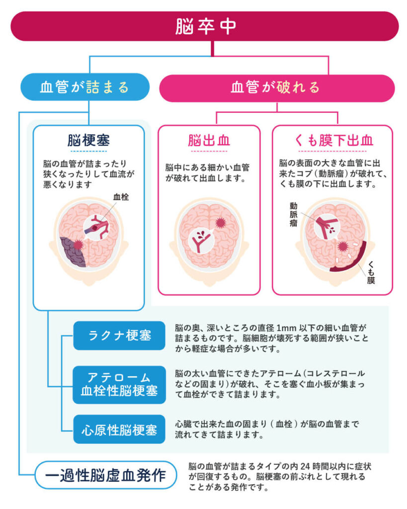 脳卒中についての説明画像