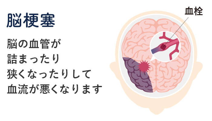 脳梗塞のイメージ画像