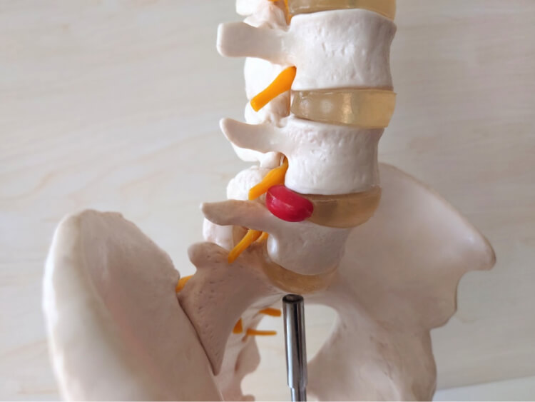 脊柱管狭窄症が悪化した場合