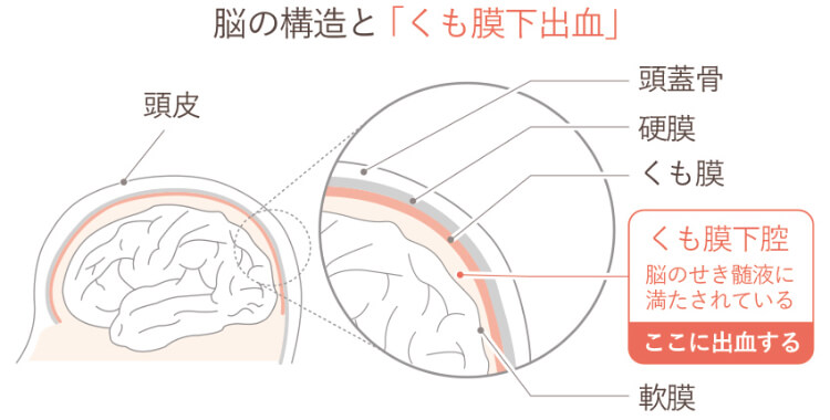 くも膜下出血の前兆とは