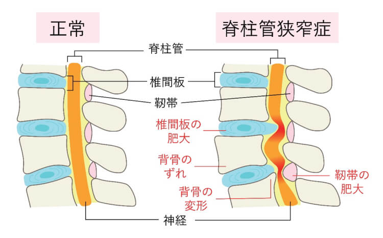 脊柱管狭窄症とは何か？