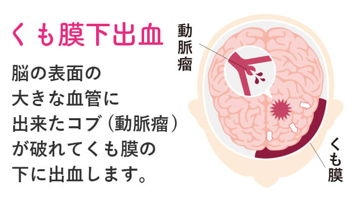 くも膜下出血とは