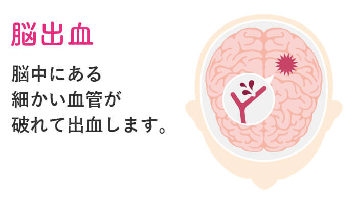 脳出血とは