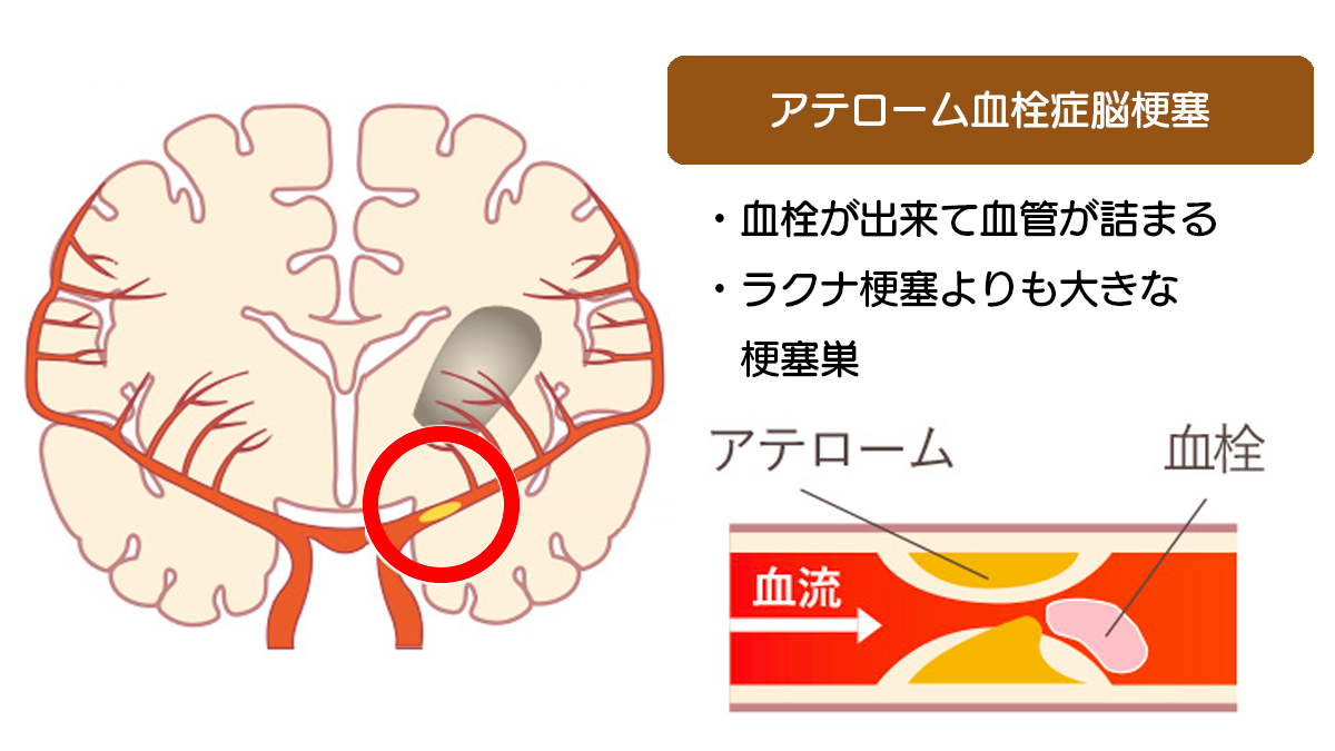アテローム血栓症脳梗塞