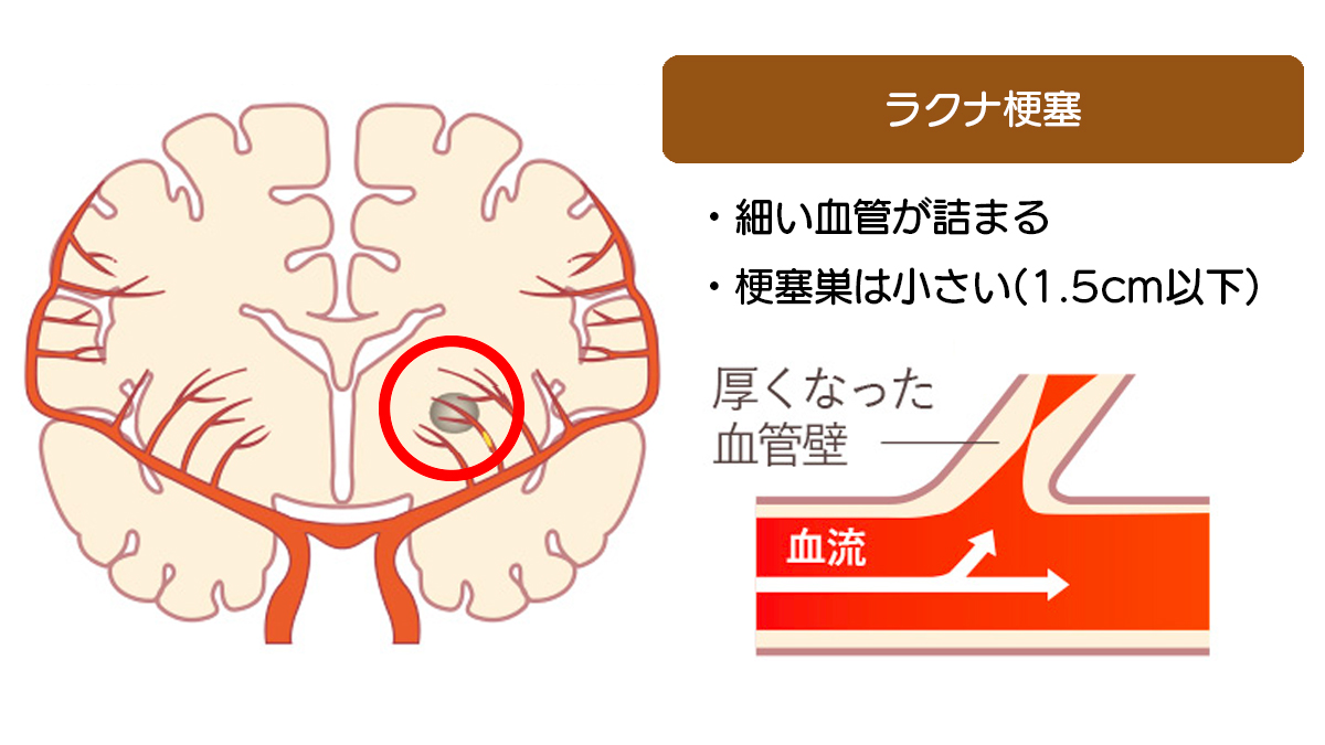 ラクナ梗塞