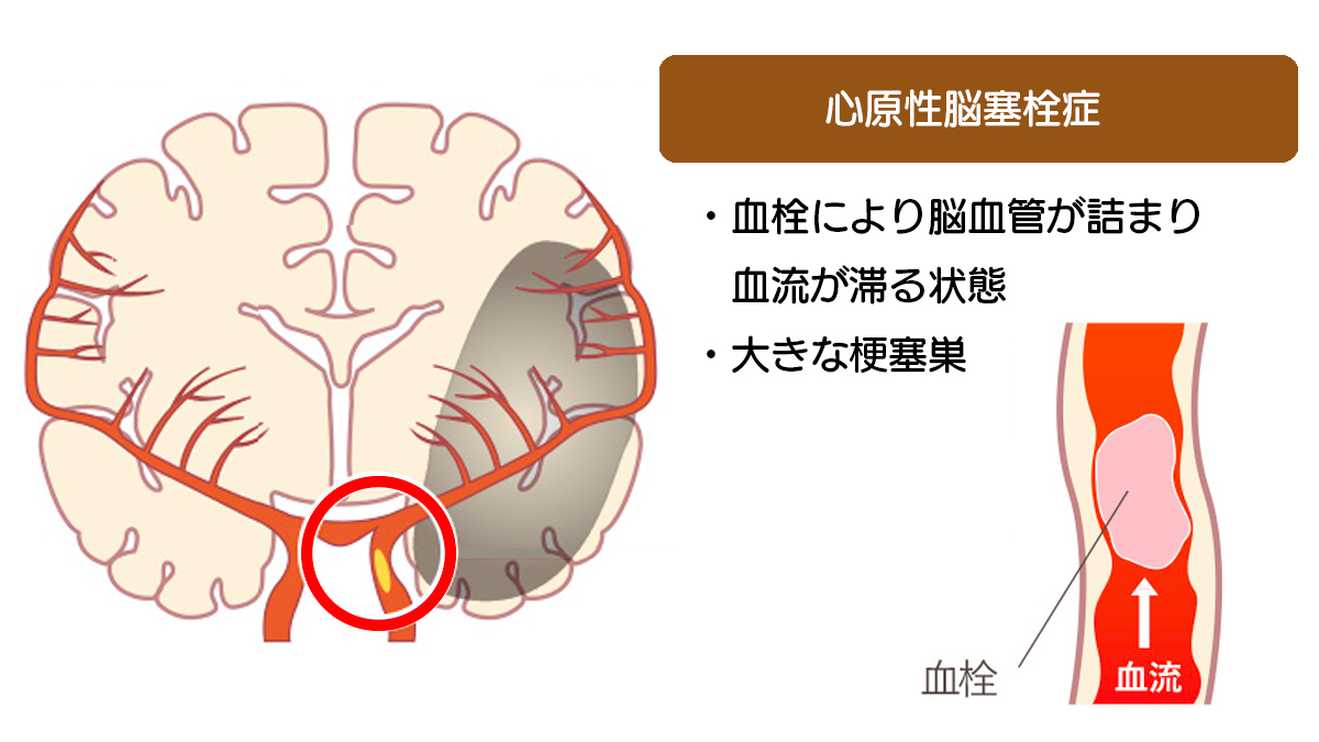 心原性脳梗塞症